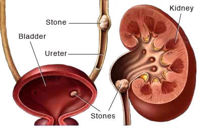 Best Doctor For Renal Stone Disease Treatment in South Mumbai