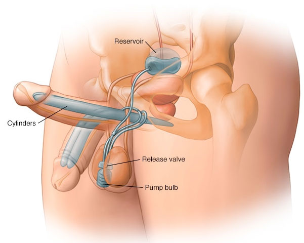 Best Doctor For Penile Implant in Mumbai